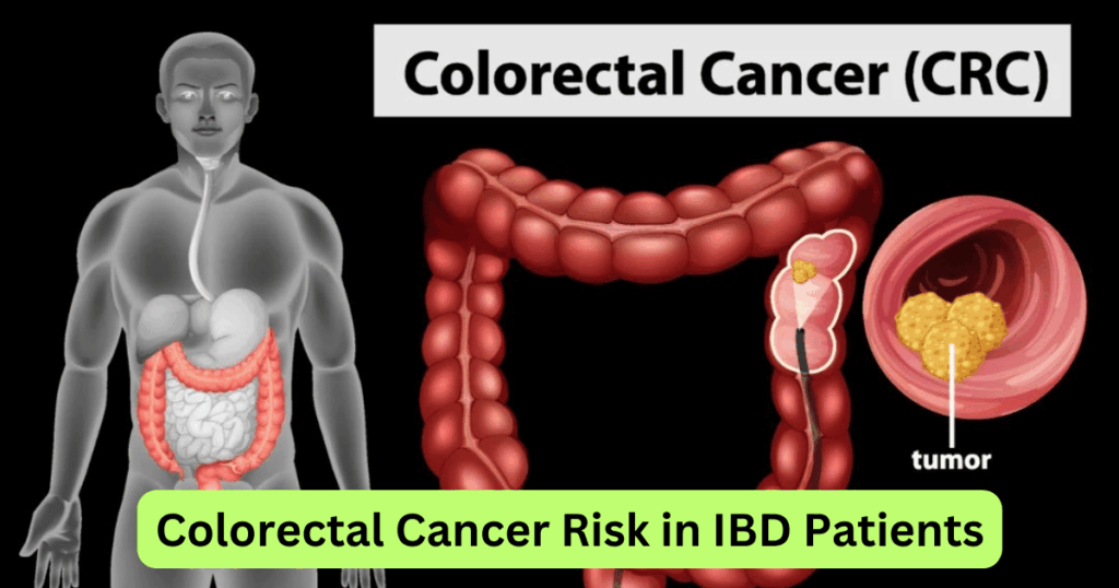 New Test Developed to Predict Colorectal Cancer Risk in IBD Patients